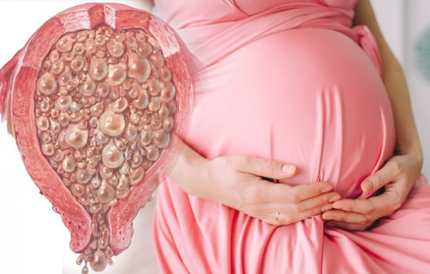 Mikä on rypäleen raskaus, rypäleen raskauden oireet
