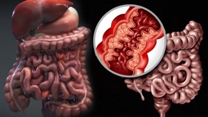 Mikä on Crohnin tauti? Mitkä ovat Crohnin taudin oireet? Onko parannuskeino Crohnille?