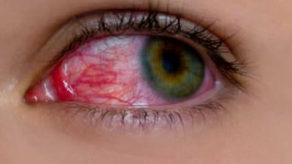 Mikä aiheuttaa silmä-allergiaa? Mitkä ovat silmäallergian oireet? Mitä hyötyä silmäallergioista? 