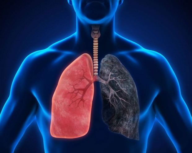 mikä on keuhkosyöpä