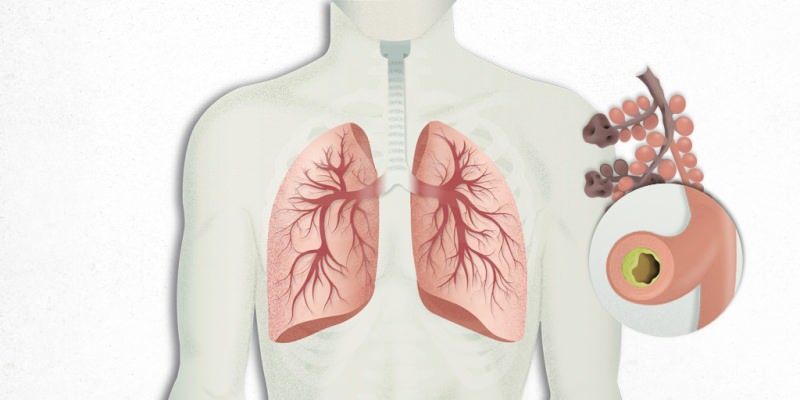 keuhkoihin asettuva virus sekoittuu keuhkokuumeen
