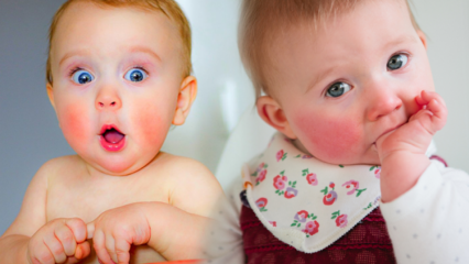 Huomio vauvoilla, joilla on punaiset posket! Ripotettu poskioireyhtymä ja sen oireet