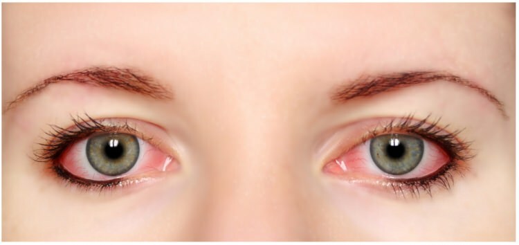 Onko ripsiväri ja silmäluomien allergia silmissä?