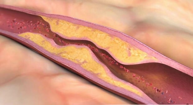 Mikä aiheuttaa ateroskleroosia? Kuinka monta verisuonitukosta on olemassa?