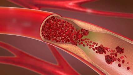 Mikä on anemia (anemia)? Mitkä ovat anemian oireet? Ruoat, jotka ovat hyvä anemiaa vastaan ​​...