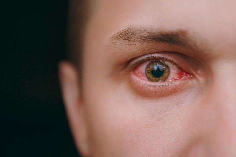 silmien kastelu, verenvuoto ja kutina koronavirusoireet