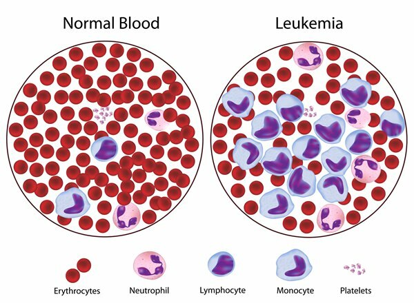 mikä on leukemia