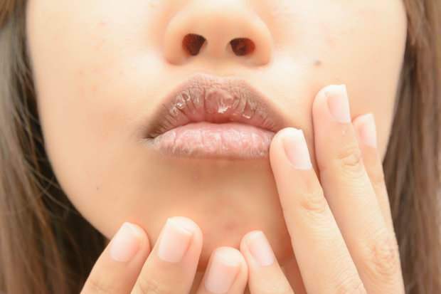 anemia aiheuttaa kuivia huulet