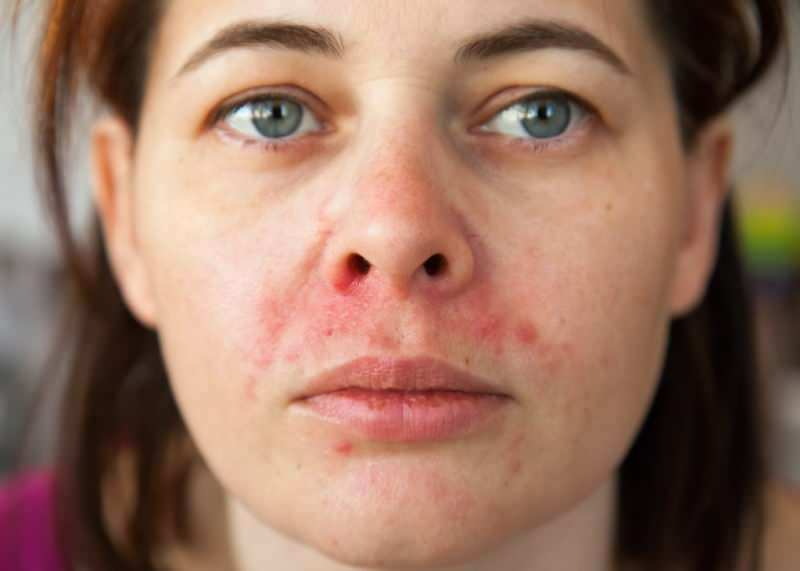 Miksi akne esiintyy huulen ympärillä? Kuinka perioraalista dermatiittia hoidetaan?