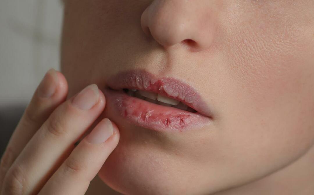 Mikä aiheuttaa tummat huulet? Miten huulten tummumista tai mustelmia hoidetaan?