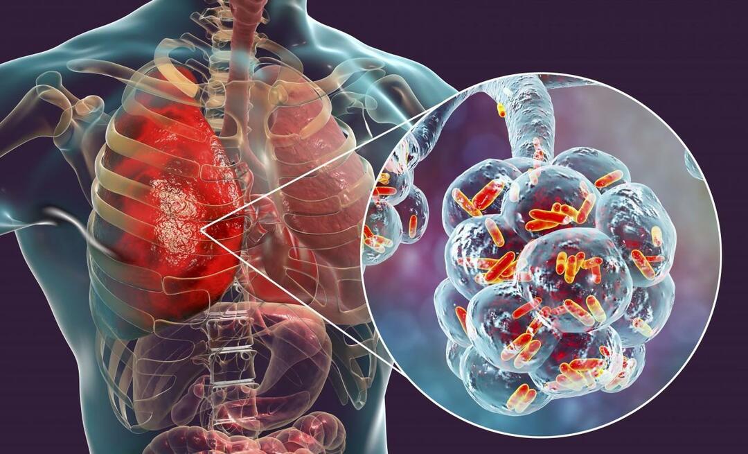 Mikä on keuhkokuume ja mitkä ovat sen oireet? Miten uutta epidemiaa pneumoniavirusta hoidetaan?