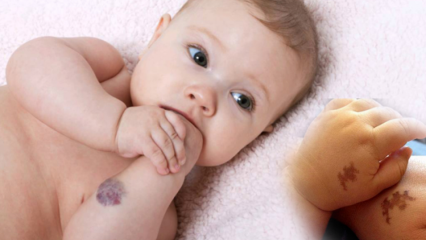 Aiheuttaa syntymämerkki vauvoissa, onko se pysyvä? Mitkä ovat syntymämerkkityypit? Parannus Saracoglulta