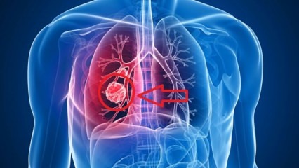 Keuhkosyövän oireet: keuhkosyövän vaiheet!
