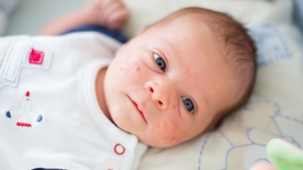 Kuinka pimples kulkevat vauvan kasvoihin? Akne (Milia) kuivausmenetelmät