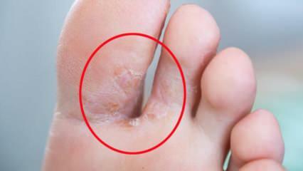Mikä on jalka-sieni? Mitkä ovat urheilijan jalan oireet? Urheilijan jalan hoito 