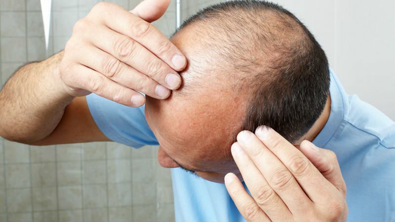 Estääkö hiustensiirto ghuslia?