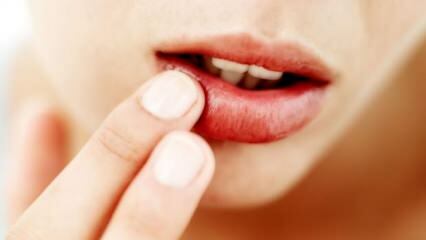 Mikä on hyvä huulien halkeilulle?