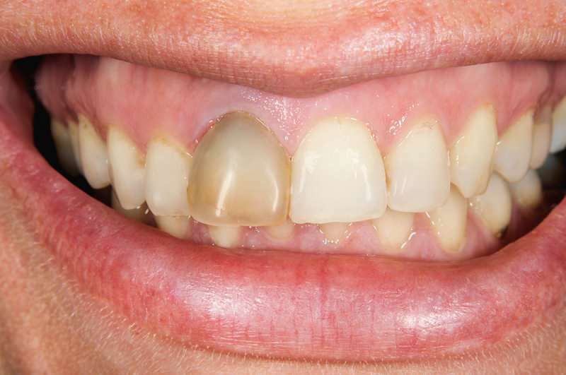 hampaiden tummeneminen voi joskus keskittyä yhteen hampaan