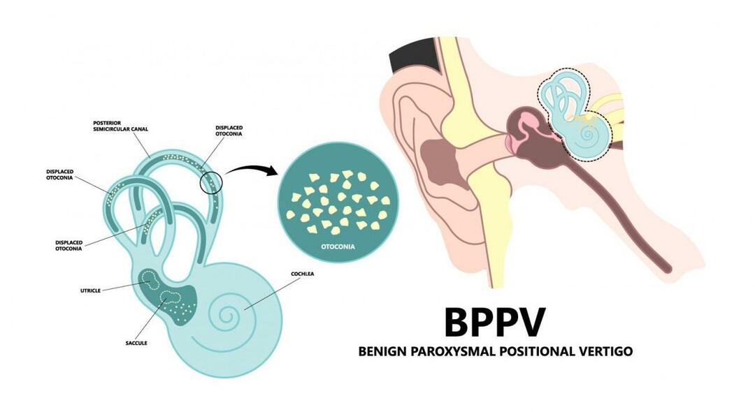 Miksi pää pyörii makuulla? Mikä on hyväksi hyvänlaatuiselle paroksismaaliselle asentohuimaukselle? Kuinka päästä eroon BPPV: stä