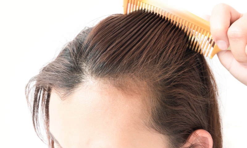 hiustenlähtö ratkaisut synnytyksen jälkeen! Mitä hyötyä hiusten menetyksestä?