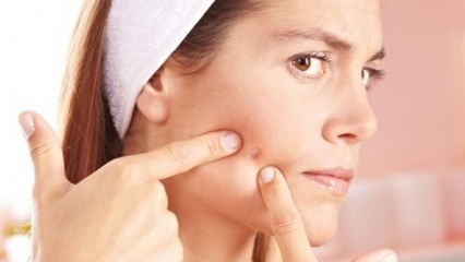 Luonnolliset hoitosuositukset pimple-iholle