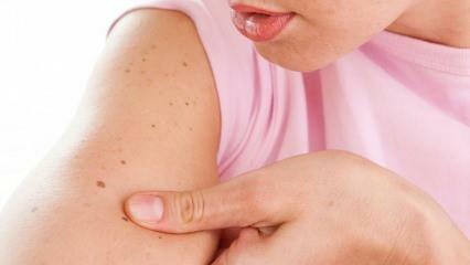 Mikä on ihosyöpä ja mitkä ovat sen oireet? Tapoja ymmärtää ihosyöpä