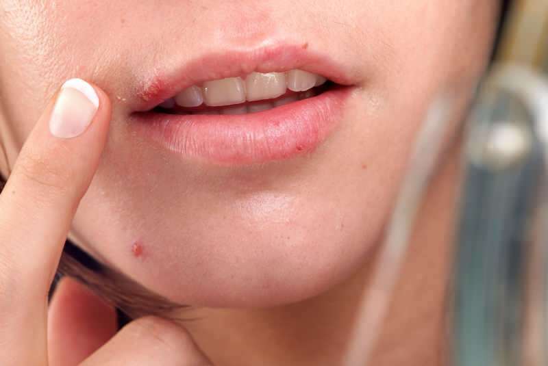 herpes esiintyy yleensä huulireunalla.