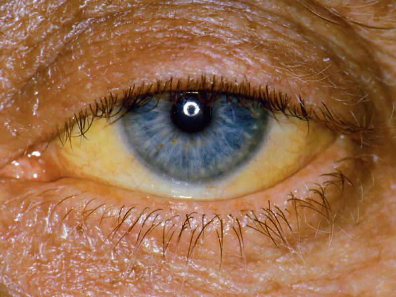 korkeus bilirubiinitasolla aiheuttaa keltaista väriä silmissä ja iholla