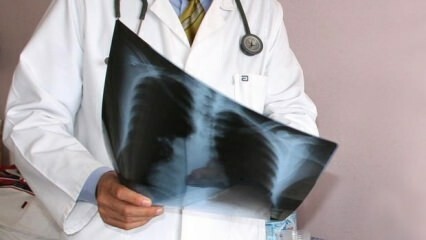 Asiantuntijat ilmoittivat! Keuhkosyöpäkuolemien määrän lisääntyminen