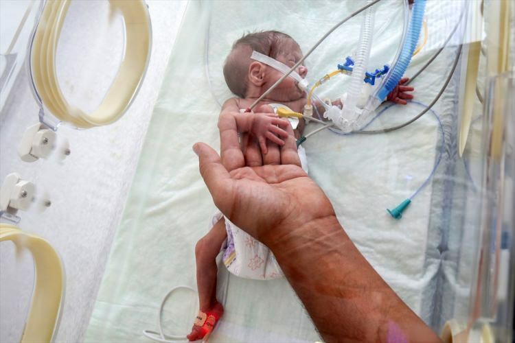 'Miracle baby' onnistui selviytymään leikkauksesta