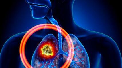 Mitkä ovat keuhkosyövän oireet? Onko keuhkosyöpään olemassa hoitoa?