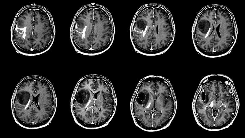 Mikä aiheuttaa aivokasvaimen? Mitkä ovat aivokasvaimen oireet? Onko aivokasvainten hoito vaikeaa?