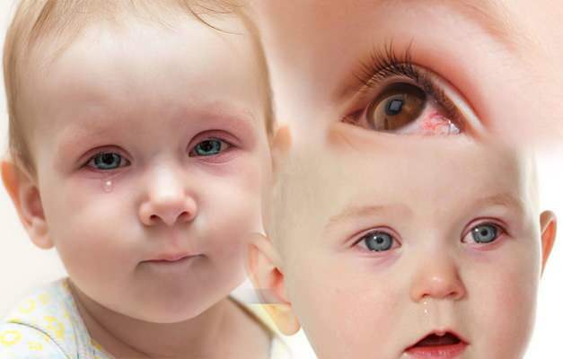 aiheuttaa silmien verenvuotoa vauvoilla