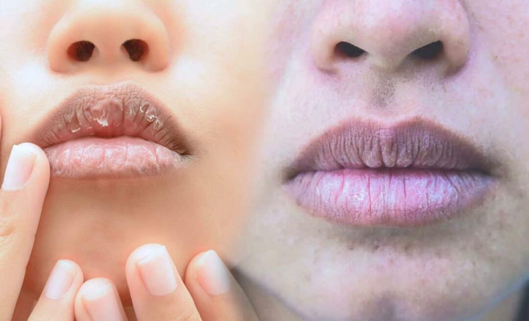 Mikä aiheuttaa tummat huulet? Miten huulten tummumista tai mustelmia hoidetaan?