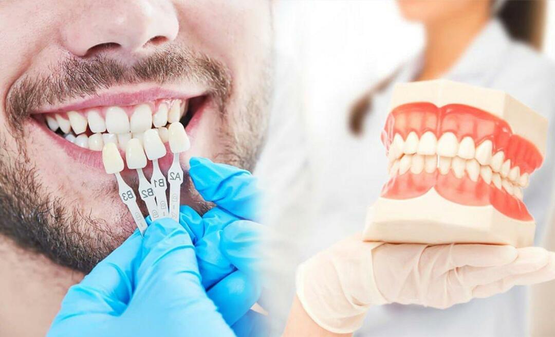Miksi zirkoniumviilua levitetään hampaille? Kuinka kestävä zirkoniumpinnoite on?