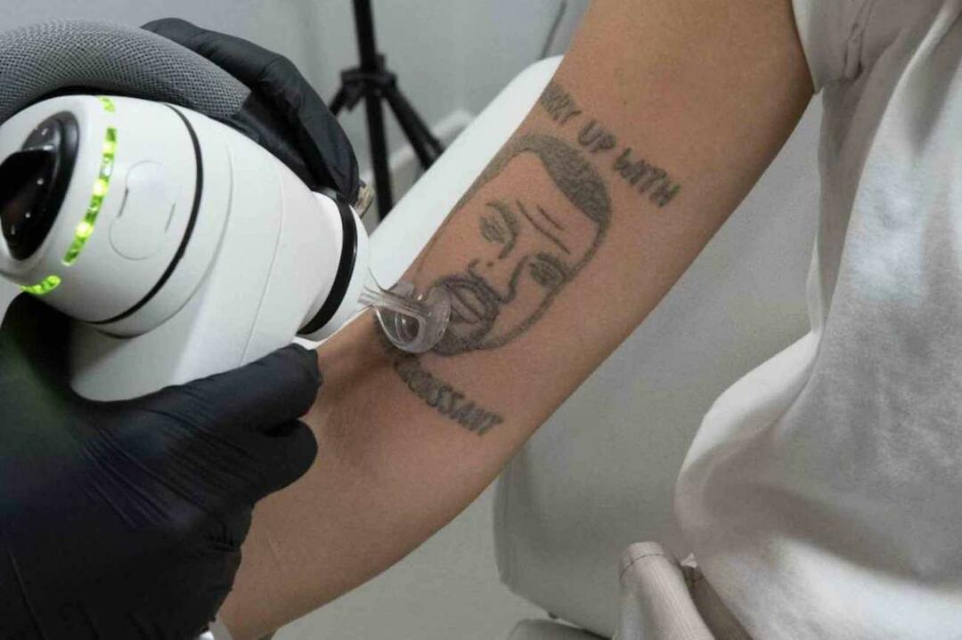 Kanye Westin tatuointi poistetaan ilmaiseksi Lontoossa 
