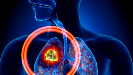 Mitkä ovat keuhkosyövän oireet? Onko keuhkosyövän hoitoa? Keuhkosyövän estämiseksi ...
