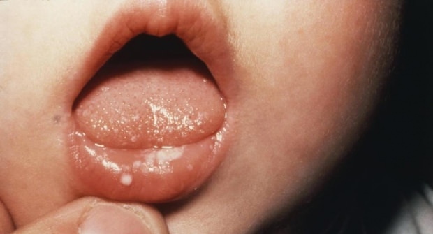 Kuinka suun haavaumat ovat vauvoilla