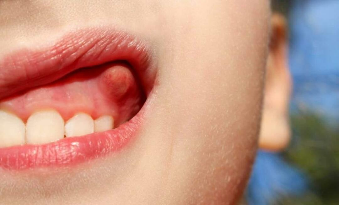 Miksi hampaan paise muodostuu ja mitkä ovat sen oireet? Hammaspaise, miten sitä hoidetaan?