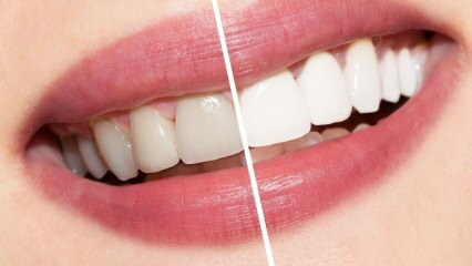 Mitkä ovat suositukset valkoisille hampaille? Hampaiden valkaisu paranna luonnollisesti kotona ...
