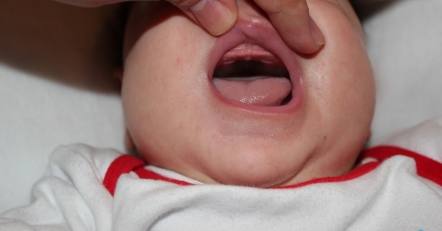 Mikä on suulaen pudotus vauvoissa, miksi? Oireet ja hoito ...