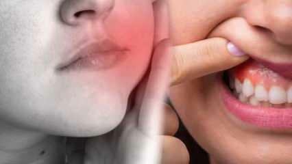 Mikä aiheuttaa hampaan paiseen? Mitkä ovat oireet ja kuinka monessa päivässä? Luonnollisia ratkaisuja hampaiden paiseeseen...