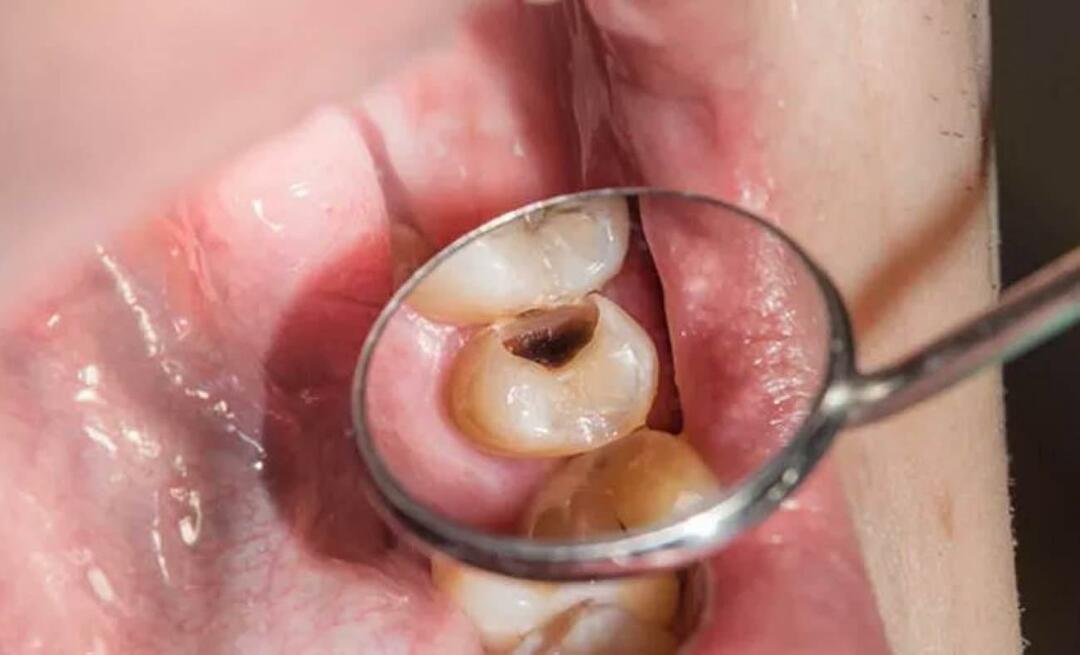 Miksi hampaat mätänevät ja mitä voimme tehdä estääksemme sen? 