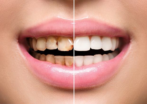 Epäterveellisen ravinnon seurauksena tapahtuu sekä hampaan värinmuutoksia että hampaiden menetyksiä