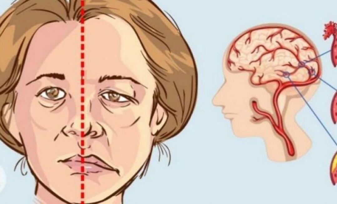 Mikä on aivohalvaus? Mitkä ovat aivohalvauksen oireet? Kuinka ehkäistä aivohalvaus?