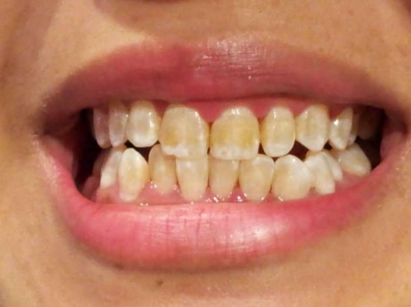 hammaskuva henkilöstä, jonka hampaat alkavat tummua