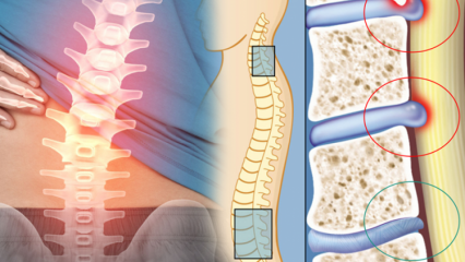 Mikä on selkäytimen kapenema? Mitkä ovat selkäytimen kaventumisen oireet? Onko selkäytimen kaventumiseen parannuskeinoa?