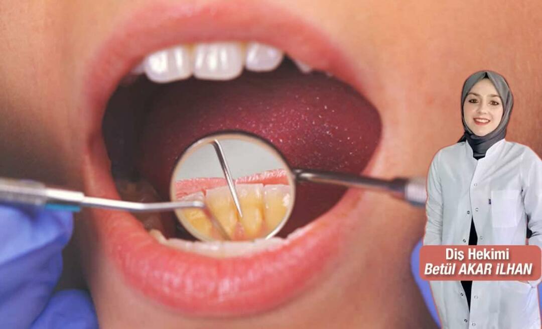 Mitä pitäisi tehdä hammaskiven välttämiseksi? Mitä hyötyä hampaiden hilseyksestä on?