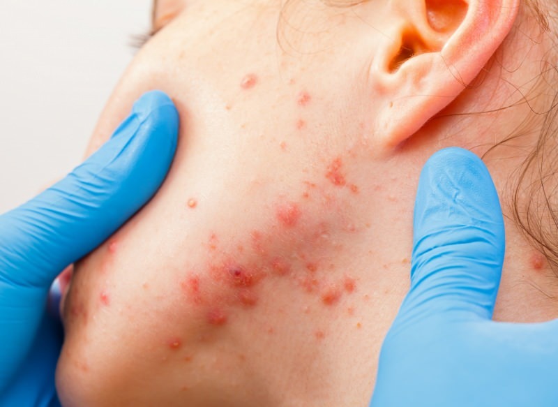 virus aiheuttaa rakkuloita ihon pinnalle