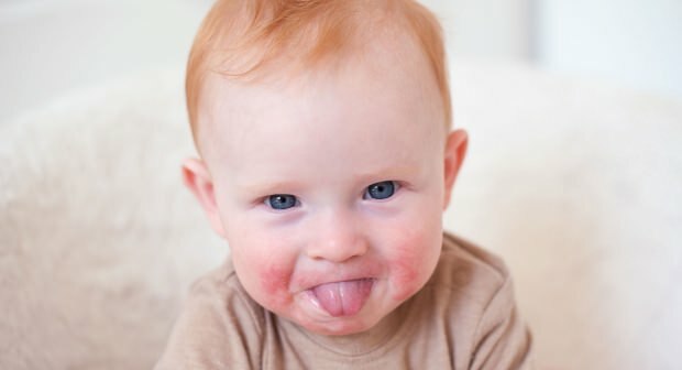 Huomio vauvoilla, joilla on punaiset posket! Ripotettu poskioireyhtymä ja sen oireet